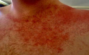 What is “Man on Fire” Syndrome and What Does it Do?