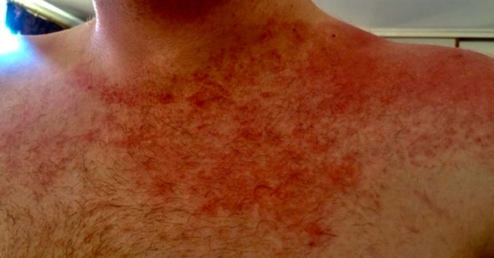 What is “Man on Fire” Syndrome and What Does it Do?