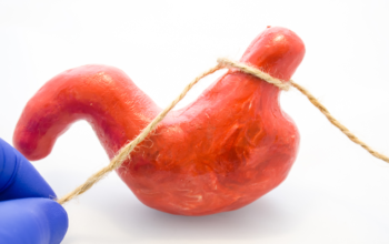 Should Bariatric Surgery be Your Weight Loss Solution?